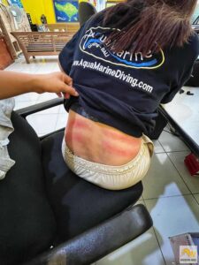 Cajuput olajjal és pénzérmével dörzsölés hátfájás ellen